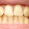 Treating Discolored and Stained Teeth: What You Need to Know
