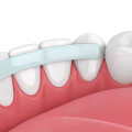 Can i get bonding using a cosmetic dental procedure?