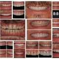 What do dentists do to your teeth before veneers?