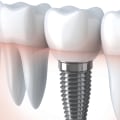 What are Dental Implants and How Can They Help You?