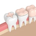 Can i get inlays and onlays using a cosmetic dental procedure?