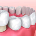 Gum Recession: What Can a Dentist Do to Help?