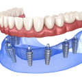 Can i replace missing teeth with a cosmetic dental procedure?