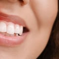 Preventing Gum Disease and Gingivitis: A Guide for Oral Health