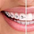What is the difference between cosmetic and authentic braces?