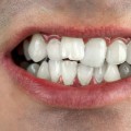 Can i straighten my teeth with a cosmetic dental procedure?