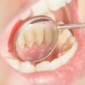 10 Strategies to Prevent Cavities and Tooth Decay