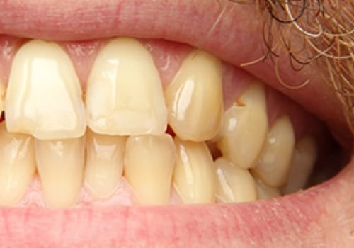 Treating Discolored and Stained Teeth: What You Need to Know