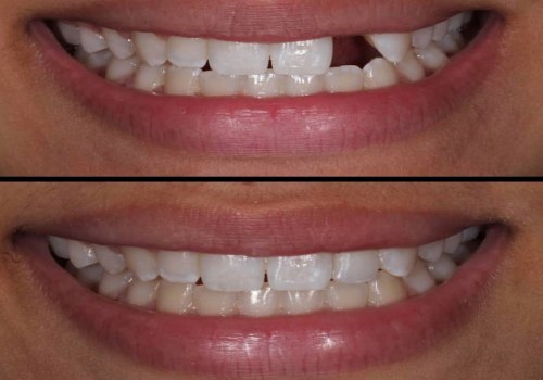 Can i close gaps between my teeth with a cosmetic dental procedure?