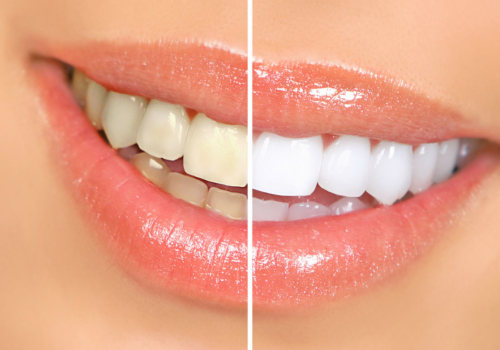 Can i get tooth bleaching using a cosmetic dental procedure?