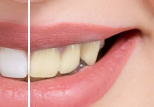 How to Safely Whiten Your Teeth at Home