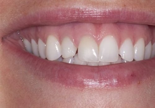 Can a dentist fix a gum line?
