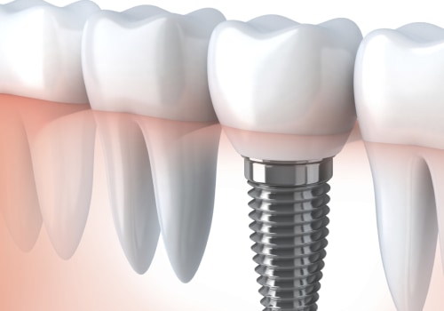 What are Dental Implants and How Can They Help You?