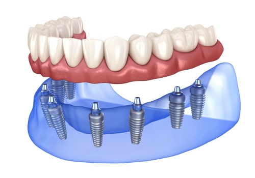 Can i replace missing teeth with a cosmetic dental procedure?