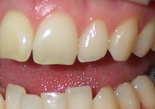 Does cosmetic teeth whitening damage enamel?