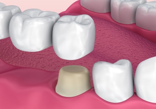 Exploring Alternatives to Dentures for Tooth Replacement
