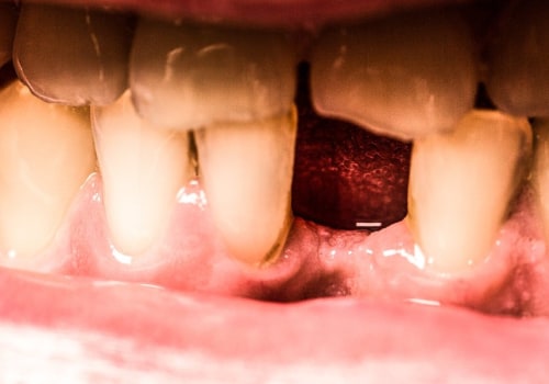 What is a Root Canal? A Comprehensive Guide