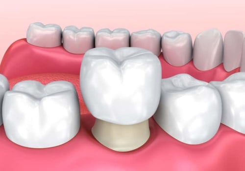 What is a Dental Crown and How Does it Help Your Teeth?