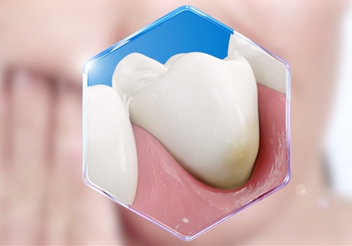 Are there any treatments available for sensitive teeth or gums?