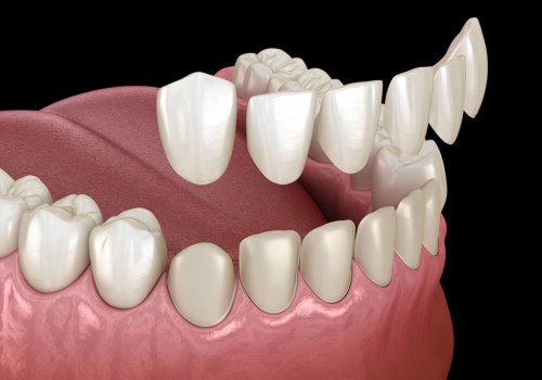 Are veneers part of cosmetic dentistry?