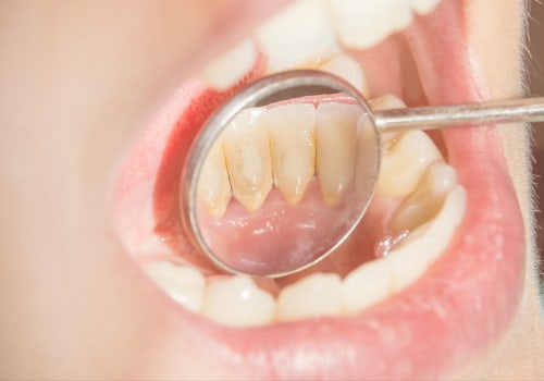 10 Strategies to Prevent Cavities and Tooth Decay